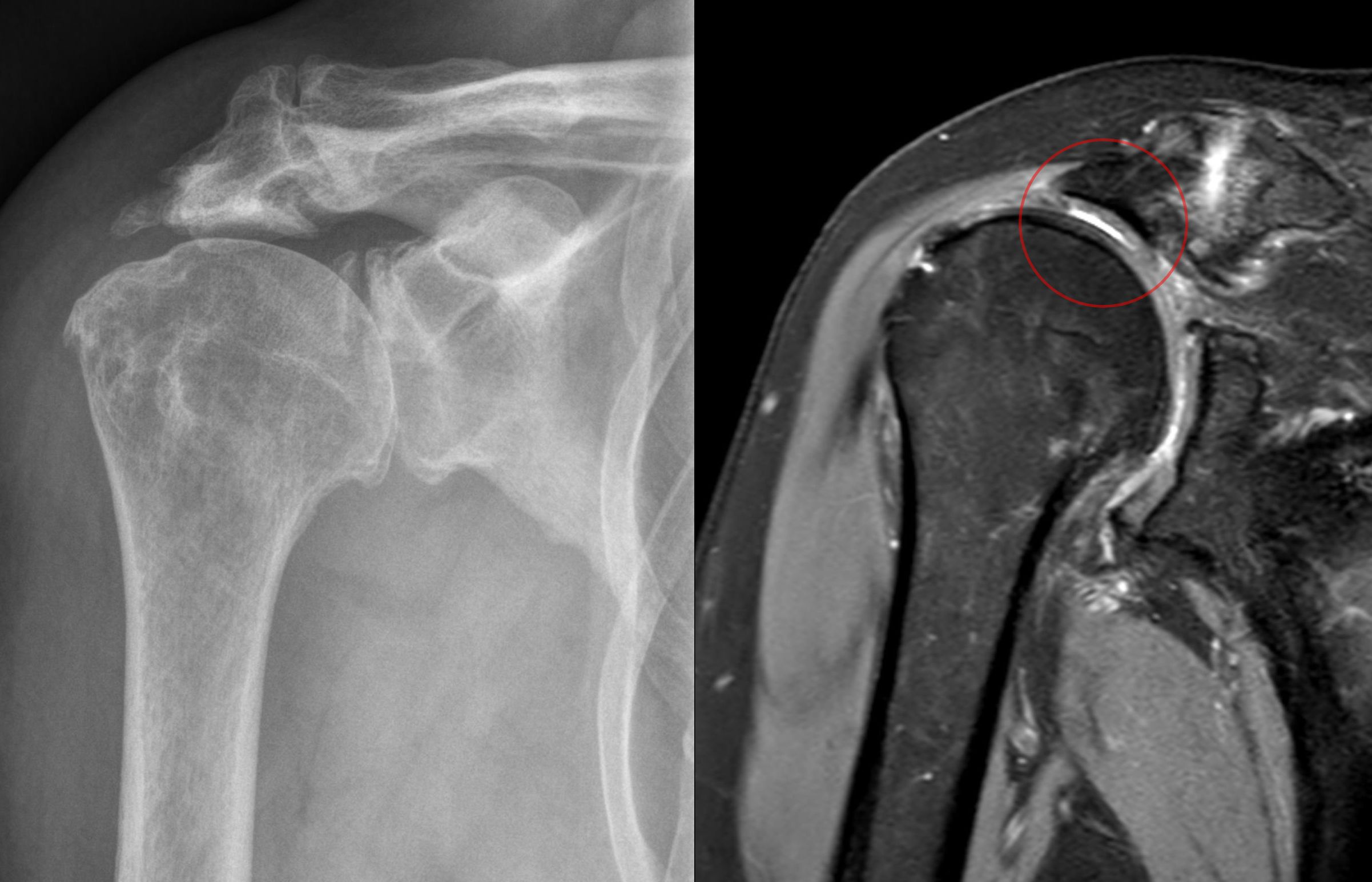 Rotator cuffen: Skulderens dybe stabilisatorer
